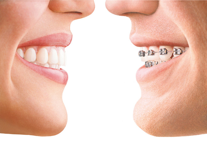 Invisalign Braces: Dentists and Dental Services in Naples FL